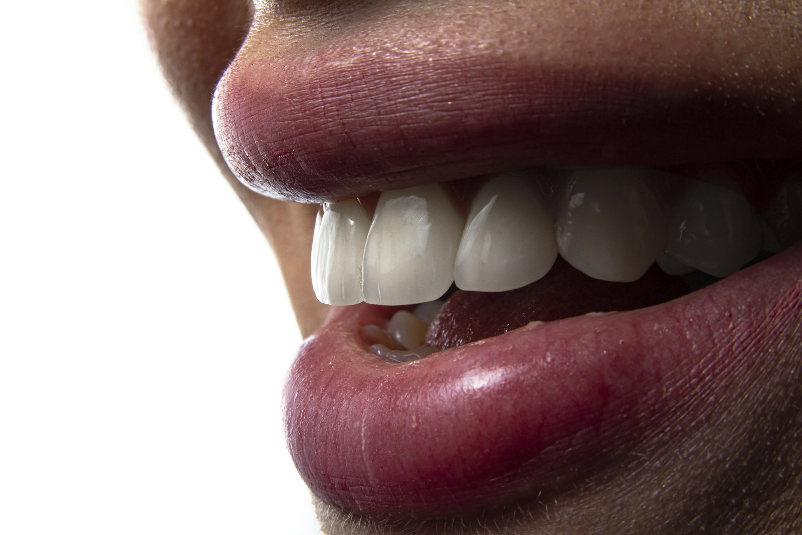 Cracked tooth at Michiana Family Dental in South Bend, IN