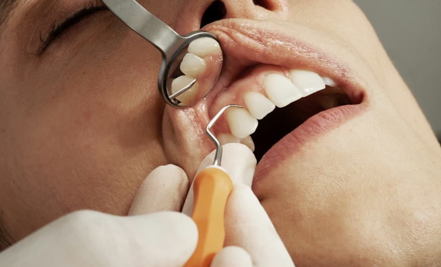 Dental bonding at Michiana Family Dental in South Bend, IN
