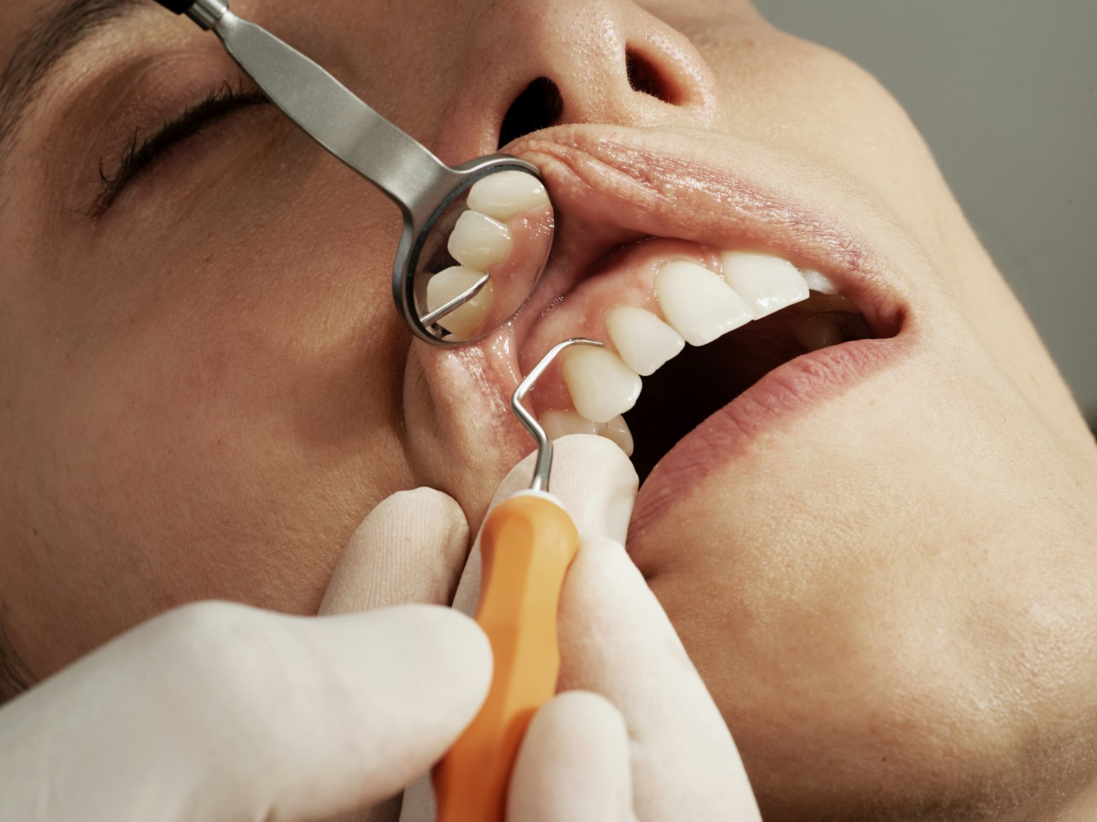 Dental bonding at Michiana Family Dental in South Bend, IN