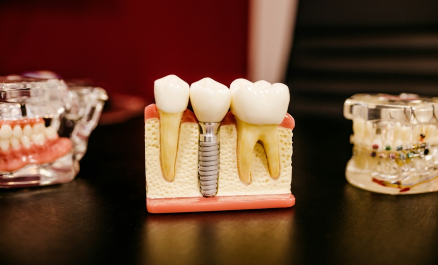 Dental bone graft at Michiana Family Dental in South Bend, IN