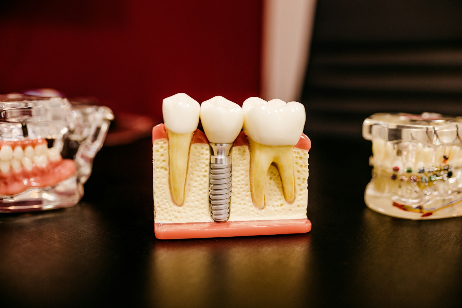 Dental bone graft at Michiana Family Dental in South Bend, IN