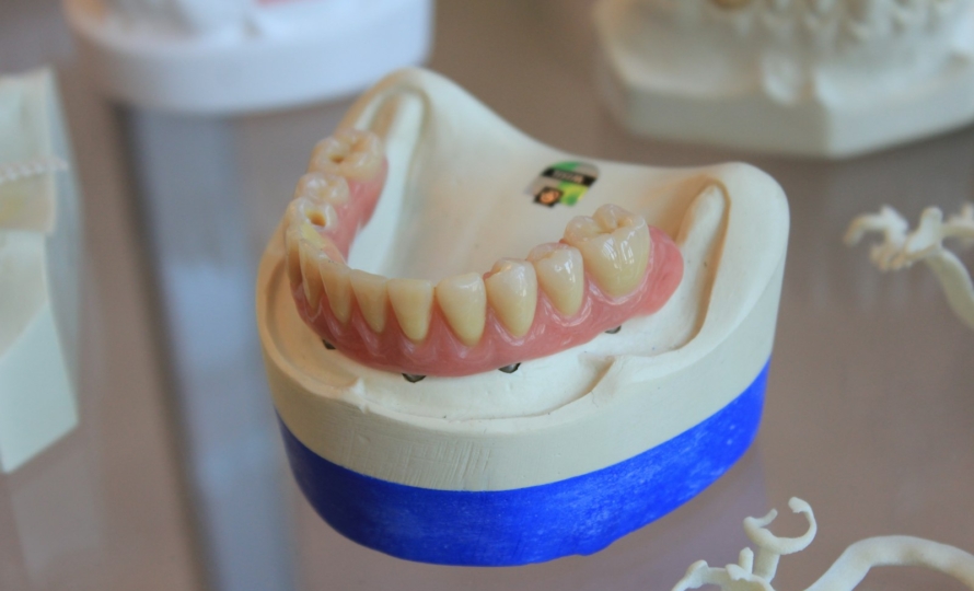 Implant-supported dentures at Michiana Family Dental in South Bend, IN