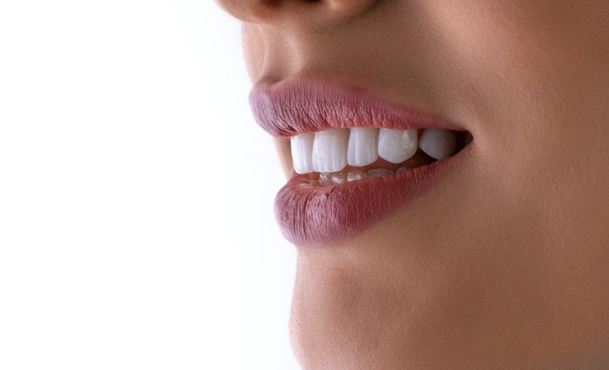Porcelain veneers at Michiana Family Dental in South Bend, IN