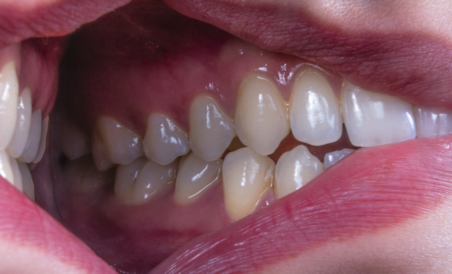 Receding gums at Michiana Family Dental in South Bend, IN