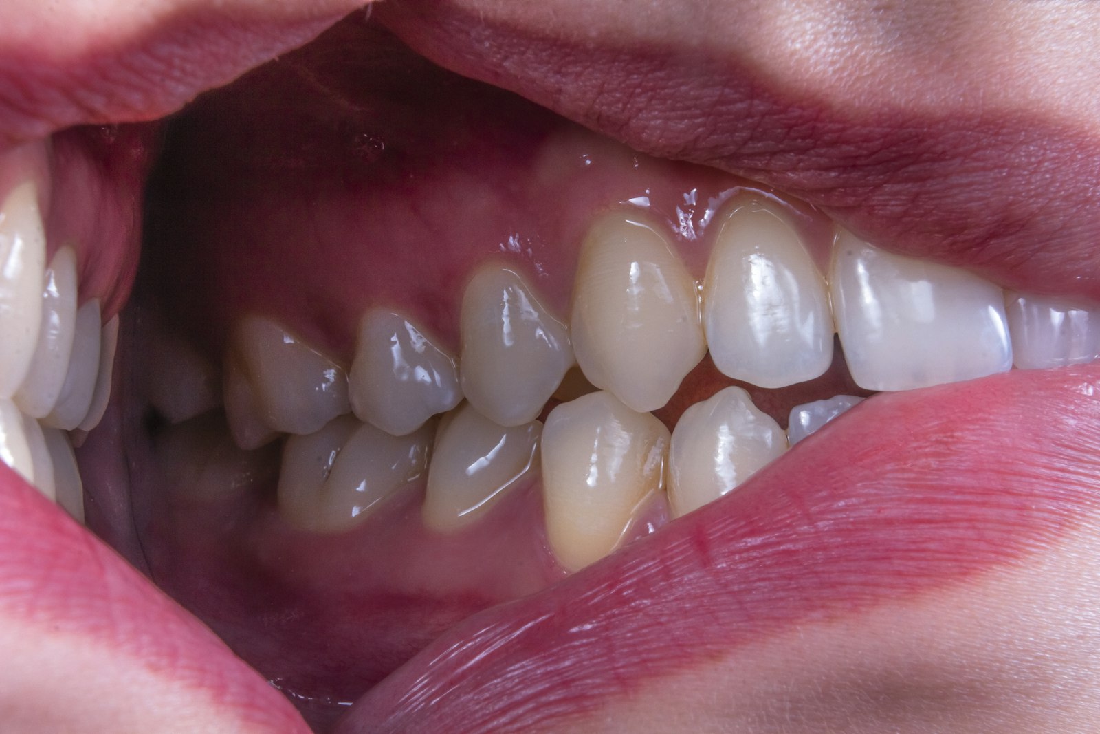 Receding gums at Michiana Family Dental in South Bend, IN