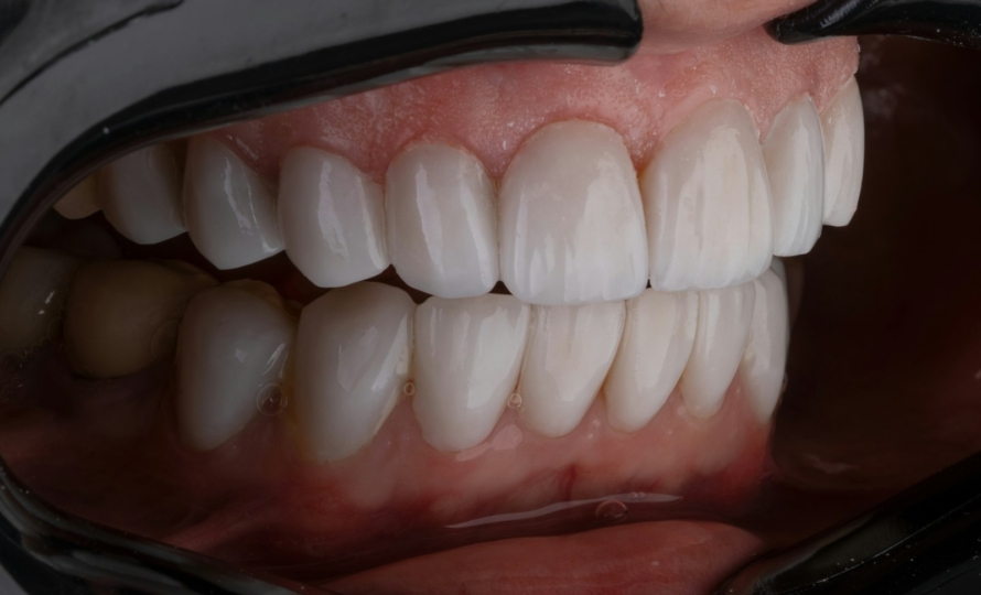 Wisdom teeth removal at Michiana Family Dental in South Bend, IN