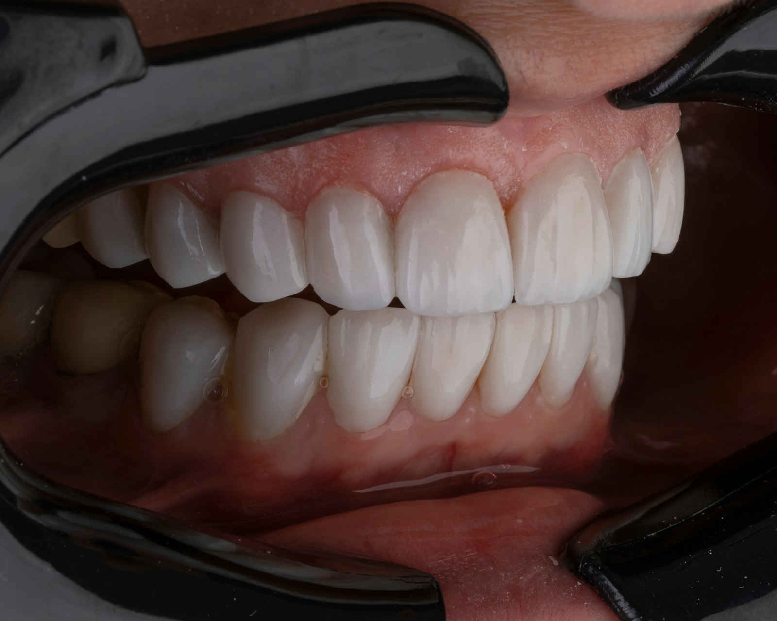 Wisdom teeth removal at Michiana Family Dental in South Bend, IN