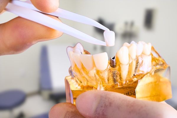 How A Dental Implant Can Replace A Missing Tooth